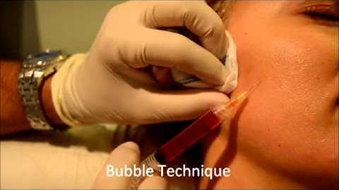 easy prp application