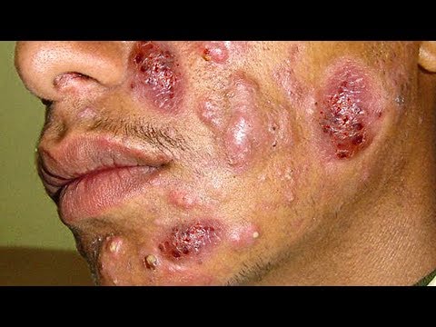 Cystic Acne!  Acne Coverage CYSTIC ACNE ON FACE - Blackheads & Whiteheads, Treatment Documentary