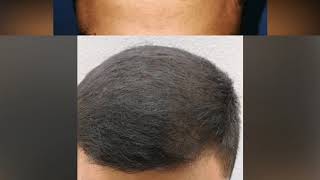Minoxidil Hair Regrowth Results / 3 Months Rogaine (Minoxidil)