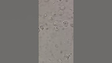 Bacteria in urine under the microscope #laboratory #urinalysis #mls  #medtechstudent #urinesediment