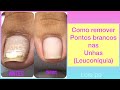 Remoção de pontos brancos nas unhas (leuconíquia )