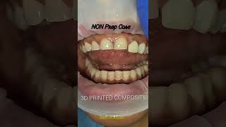 Comment 3d to learn 3d printed non Prep veneers. #dentist #3dprintingdentistry #dentistry