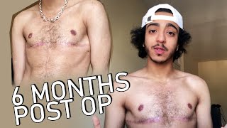 6 months post top surgery | ftm