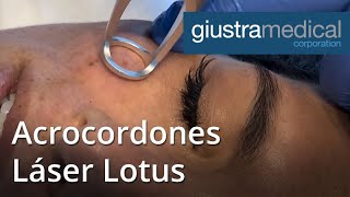 Acrocordones - Láser Lotus (21056)