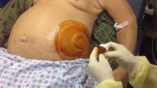 paracentesis drainage of abdominal fluid