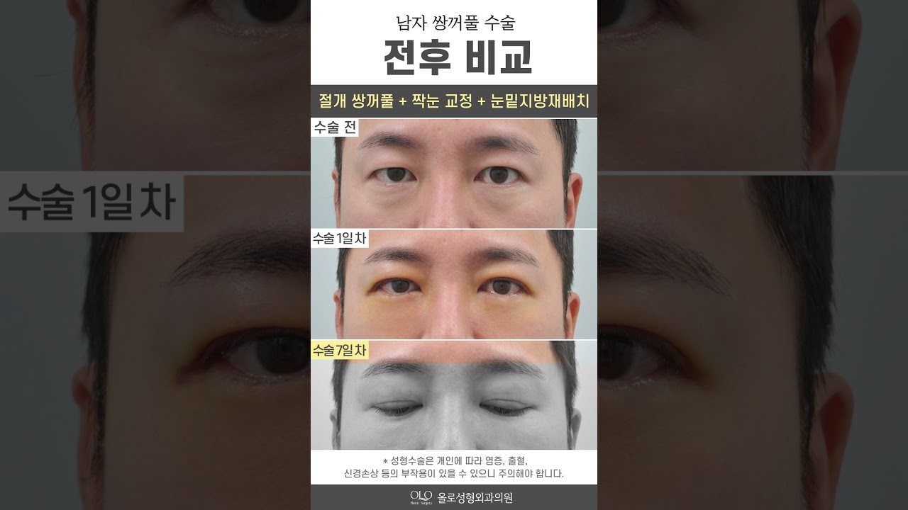 [奧羅整形外科診所] #祛除黑眼圈很簡單 沒什麼大不了的～ 簡直像開眼了一樣！ #短片