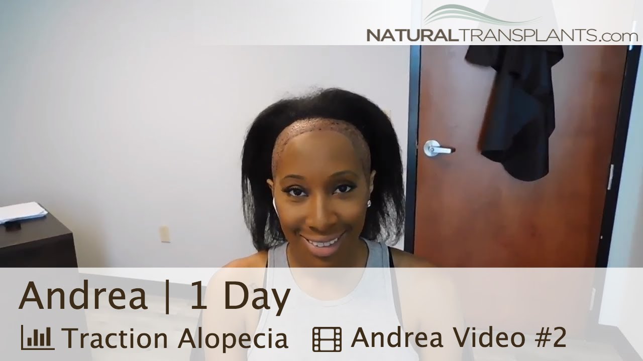 fue hair transplant month by month How to Cure Alopecia | Alopecia Treatment 1 Day Follow-up (Andrea)