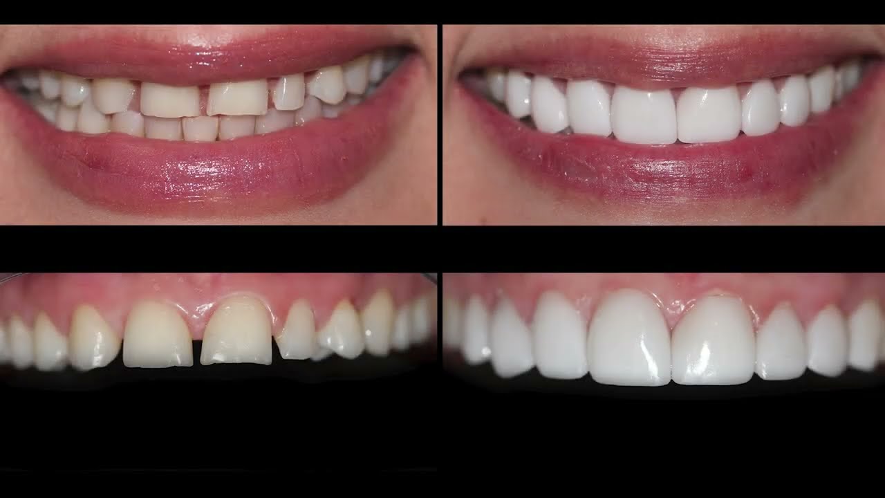 Porcelain Prepless Dental Veneers Cosmetic Dentistry in San Antonio, TX.
