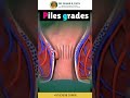 Piles Grading Explained | Proctology | Dr Suhas Patil