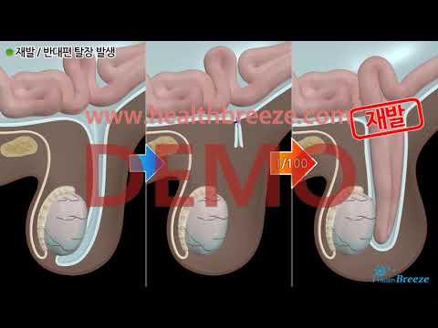 [시연용] c0262aako_복강경 서혜부탈장 교정수술 안내 [동의서용]