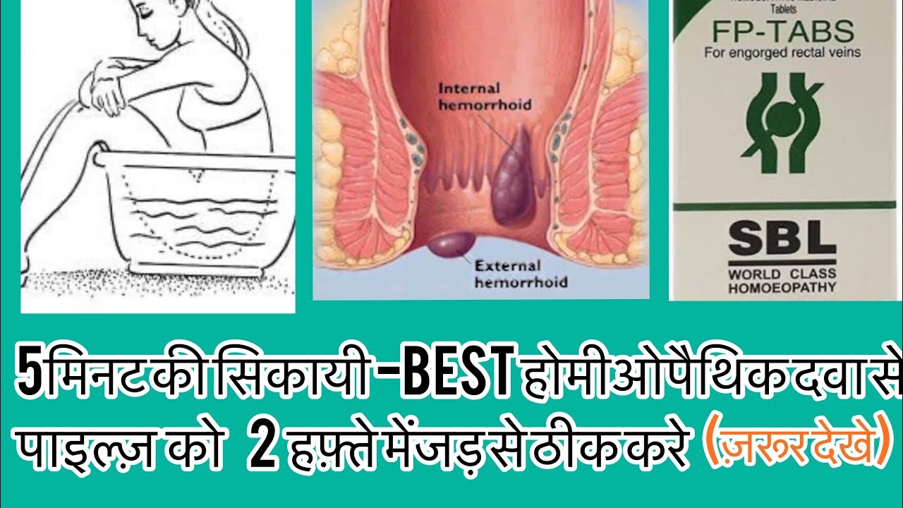 पाइल्ज़?Homeopathic Medicine For Piles-homeopathy for Haemorrhoids-?Dr Rukmani Choudhary Homeopath