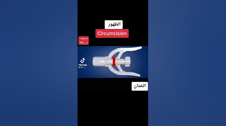 عملية الختان (الطهور) الحديثه