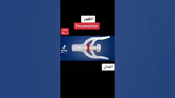 عملية الختان الطهور الحديثه 