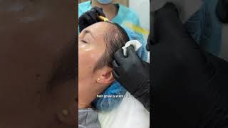 The best Stem Cell treatment for Hair Loss in Medellin Colombia