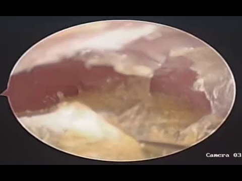 Video Bóc lấy mảng ráy tai quá đã (Part 4) - youtube