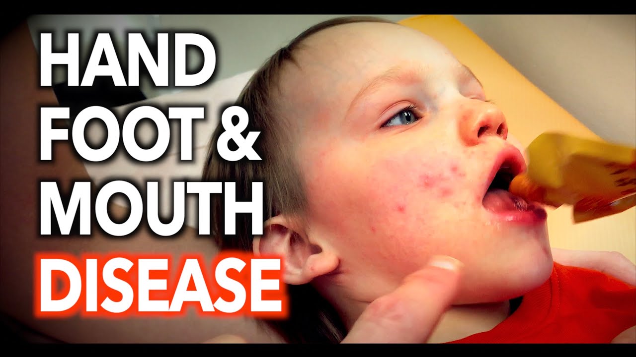 Hand Foot And Mouth Disease Dr Paul Youtube