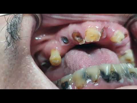 Yaygın çürük dişleri ve kökleri olan hastada alt üst porselen köprü ve çivili dolgular ile tedavisi