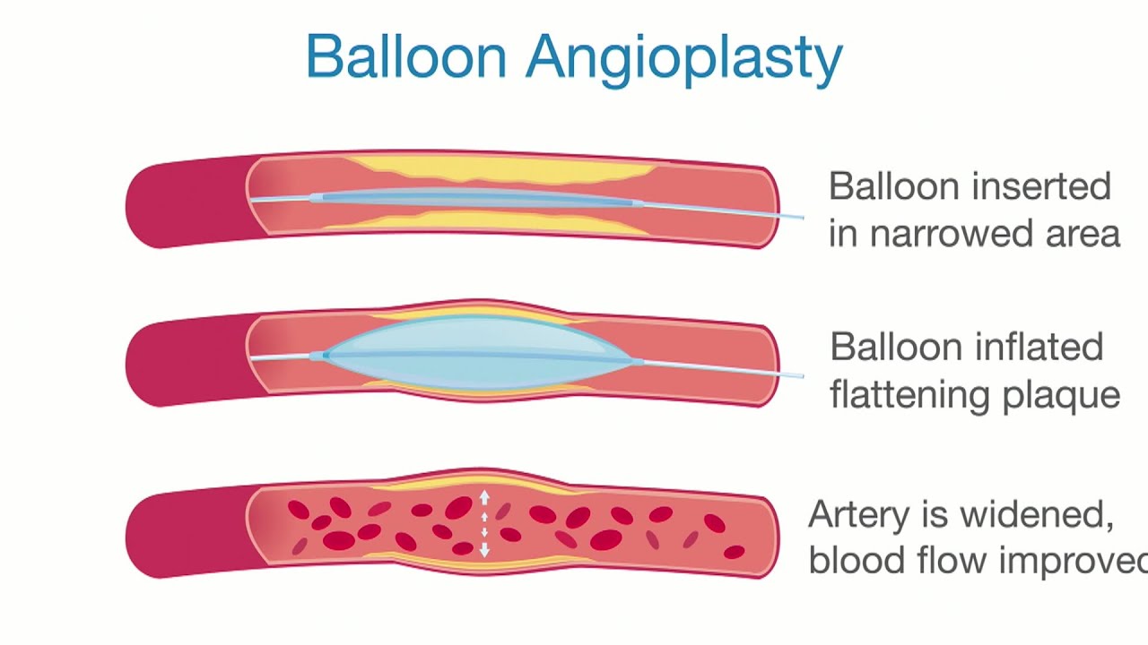 PAD and Surgery YouTube