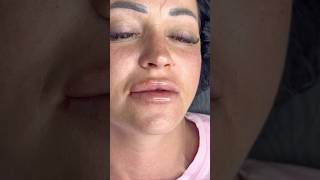 2мл это не огромные губы как думают многие ,а очень даже натуральный эффект 🌹 #косметологростов