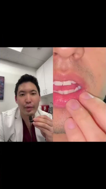 #shorts Dermatologist Explains Canker Sores