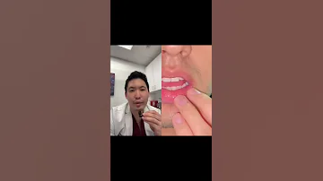 Shorts Dermatologist Explains Canker Sores 