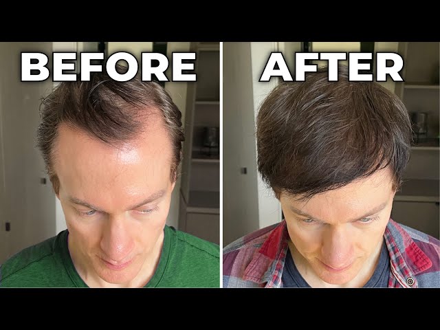How I Reversed My Hair Loss + Greying class=