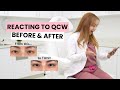 Reacting to My Patients' Before and After Results #eyelid #QCW #shonanbeautyclinic