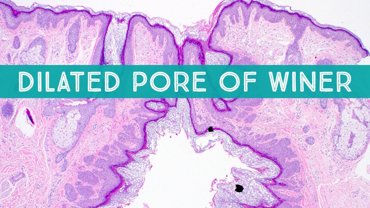 Dilated Pore of Winer: Under Microscope (Dermpath in 5 Minutes) - YouTube