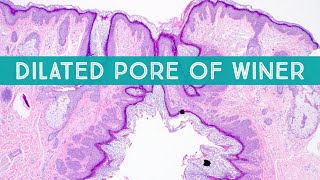 Dilated Pore Of Winer Under Microscope Dermpath In 5 Minutes