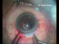 Capsular tension ring and iol implantation