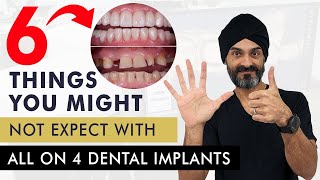 6 Things You Might Not Expect With All On 4 Dental Implants Or A Full Mouth Of Dental Implants