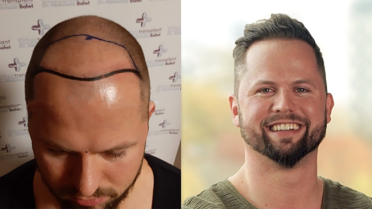 Zweite Haartransplantation Das Solltest Du Beachten Youtube