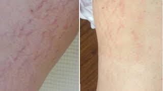 Лазерное удаление растяжек. Эффект через неделю после процедуры (до и после) Лазерное удаление растяжек. Эффект через неделю после процедуры (до и после)