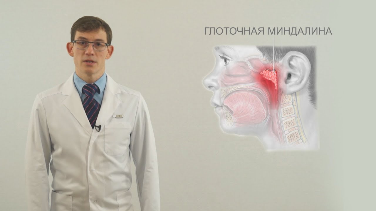 Аденоиды у детей - YouTube
