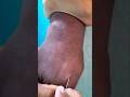 How to Cannulate A Beginner's Guide#neet #ivcannulation #nurse# shorts #trending #mhbmedico#doctor