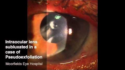 Lens Subluxation after cataract surgery In Pseudoexfoliation Syndrome