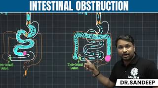 intestinal obstruction | Surgery | Bailey learned with Dr. Sandeep