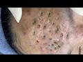 Ultimate Blackhead Removal for Relaxation 😌