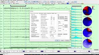 EEG FFT Frequency Maps in Persyst 14