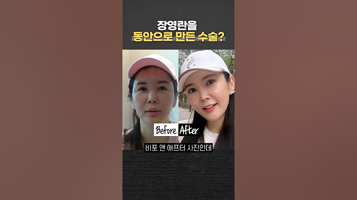 "장영란, 성형 후 달라진 인상?" 성형외과 원장이 분석한 장영란 눈수술 브이로그