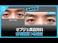 非切開目つき矯正