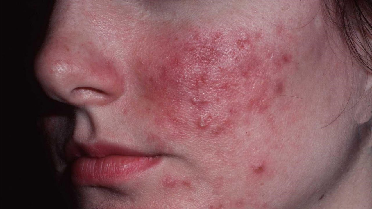 Rosacea - Huidarts.com