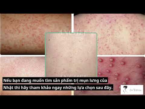 Top các sản phẩm trị mụn lưng của Nhật hiệu quả tốt nhất