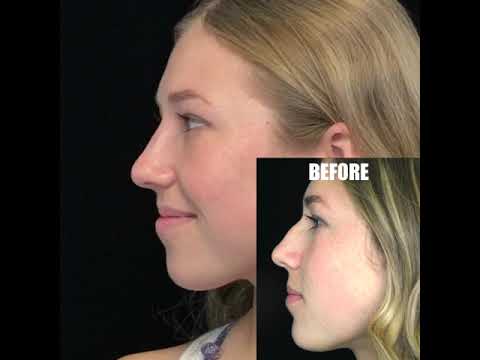 Video thumbnail: Teenage Scarless Nose Rhinoplasty Two Week Reveal with Dr. Deepak Dugar, MD Beverly Hills