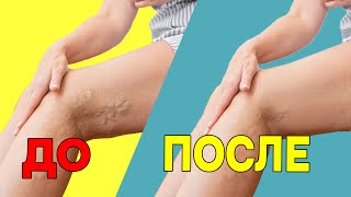 Три упражнения от варикоза | Гимнастика против варикозного расширения вен