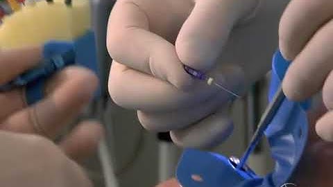 Access Preparation - Finding the MB2: Case I: Advanced Endodontics