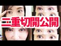 【二重切開】術後の1週間の経過を全て公開します【目のたるみを取って若返りたいのだ】