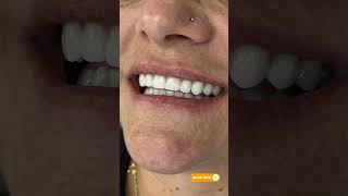 A complete smile transformation 🦷With 7 dental implants and 27 zirconia crowns.