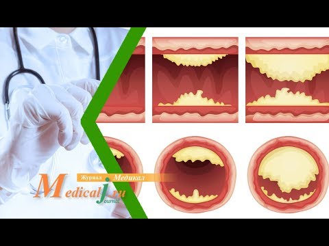 Облитерирующий атеросклероз нижних конечностей. Причины, симптомы и лечение