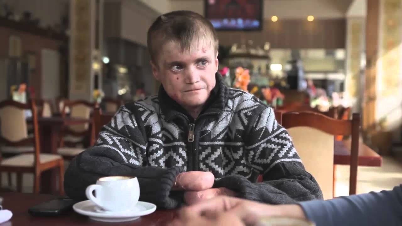 Про Дэбра Молдова и Буллёзный Эпидермолиз!!